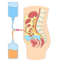 Peritoneal dialysis